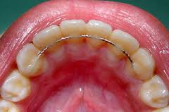 зубы после брекетов